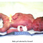 one of the babies reportedly aborted by Gosnell