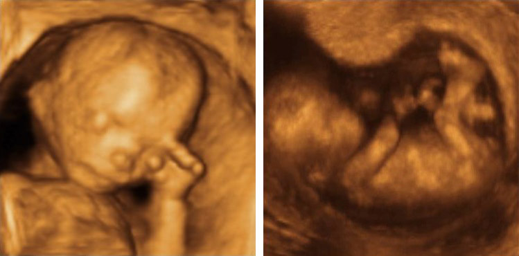 new ultrasound technology pictures life in the womb